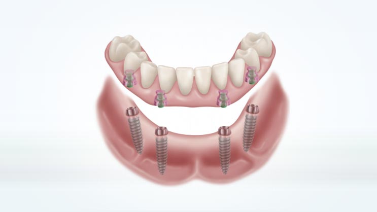 Hybrid denture